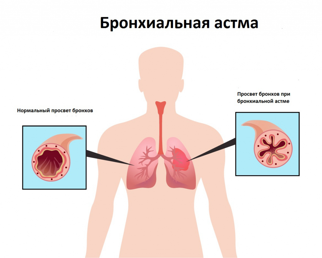 бронхиальная астма.jpg
