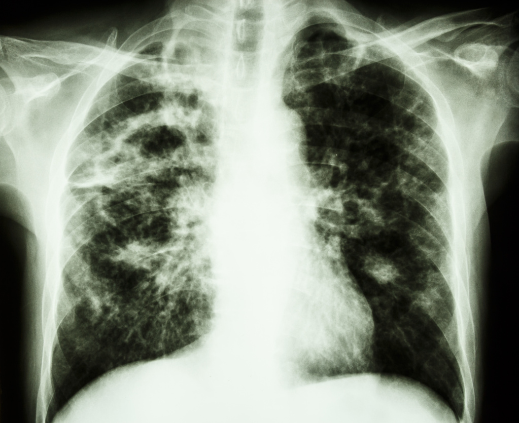 Рентгенограмма органов грудной клетки пациента с туберкулезом и распадом легочной ткани, лучше всего видно в правых верхних отделах.jpg