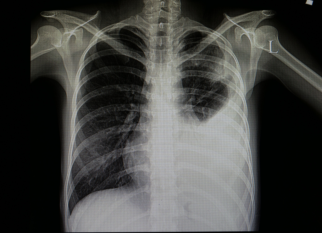 Рентгенограмма органов пациента с левосторонней крупозной пневмонией.jpg
