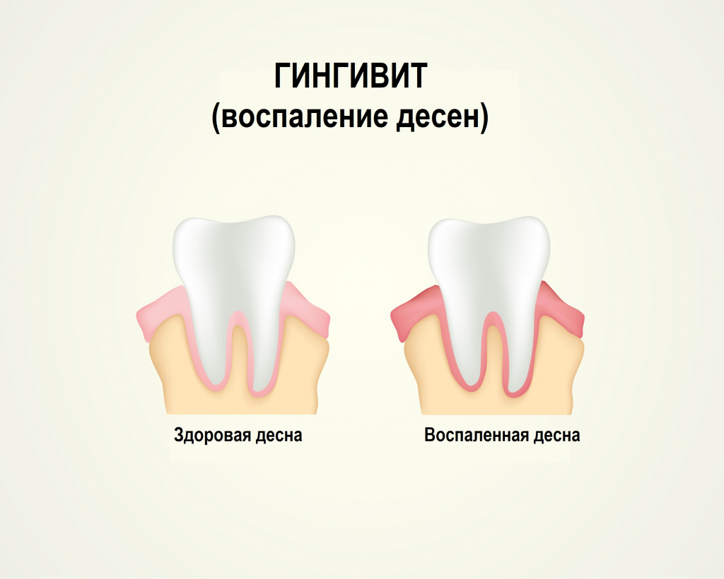 Гингивит.jpg Гингивит.jpg
