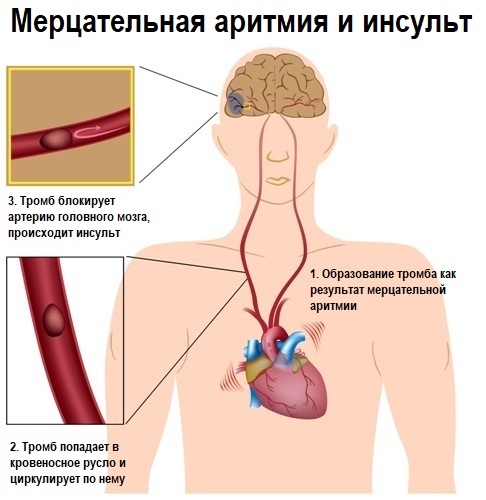Инсульт.jpg Инсульт.jpg