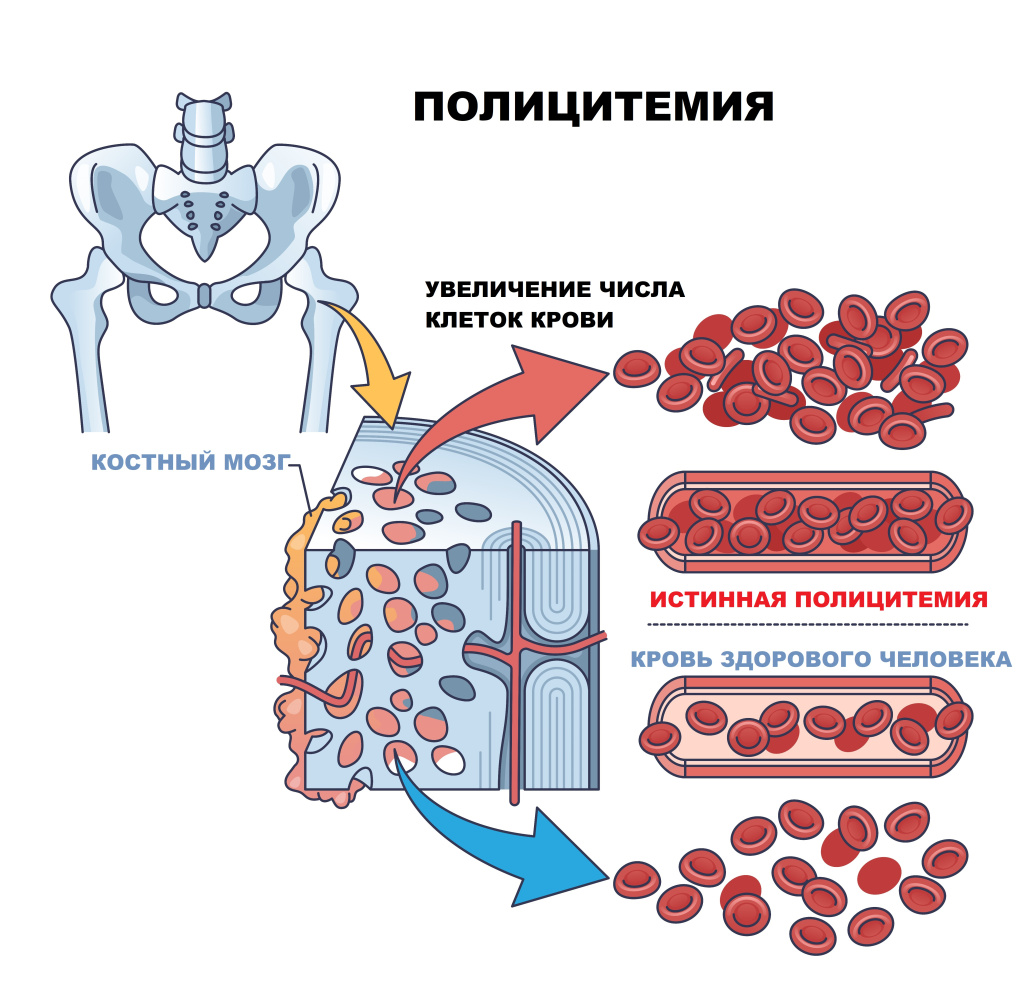 Полицитемия.jpg