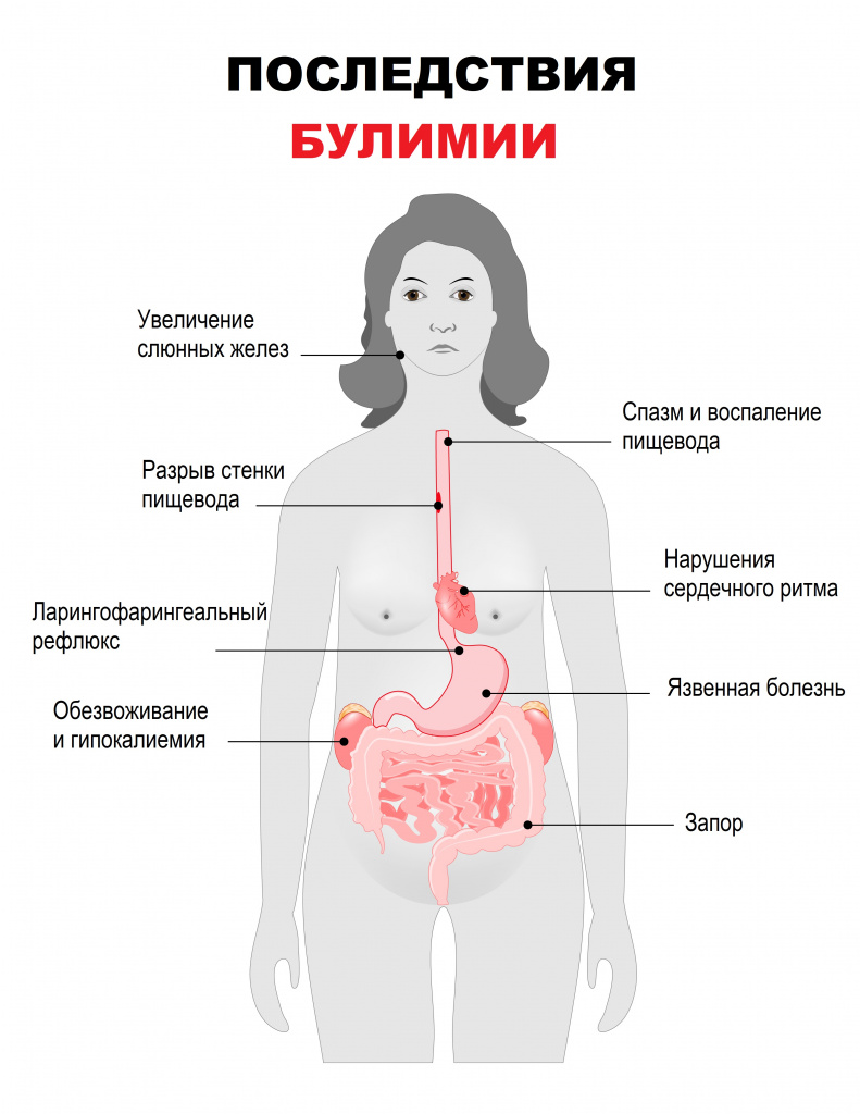 Последствия булимии.jpg