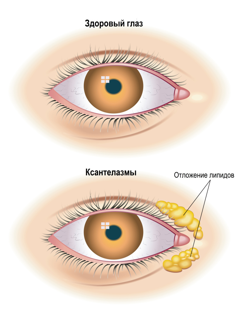 Ксантелазма.jpg