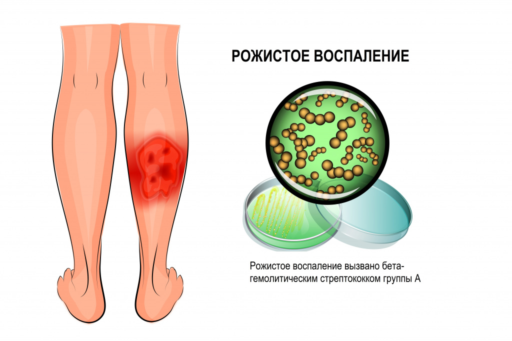 Рожистое воспаление.jpg