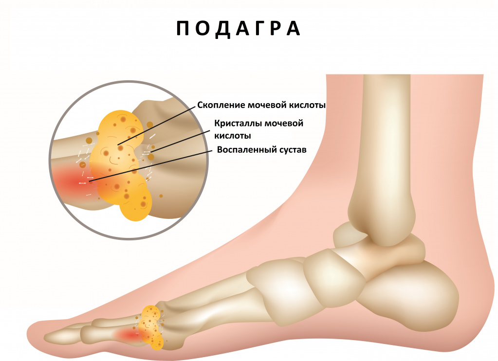 Подагра.jpg