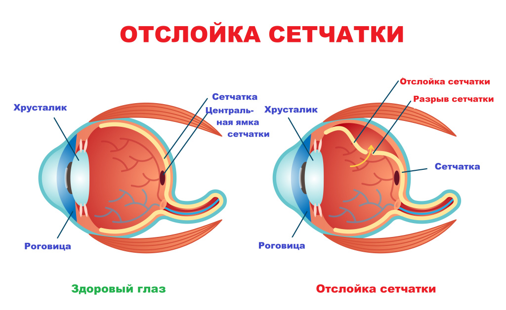 Отслоение сетчатки.jpg