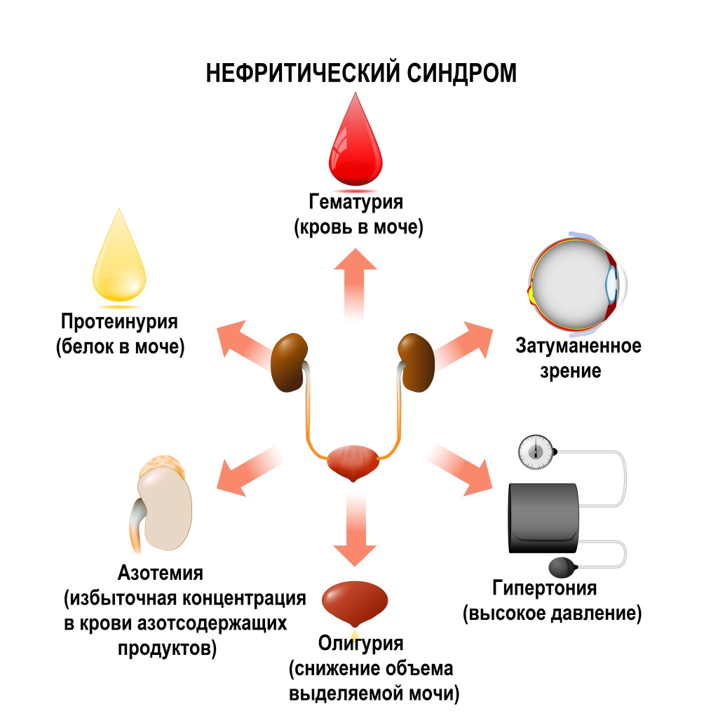 Нефритический синдром.jpg
