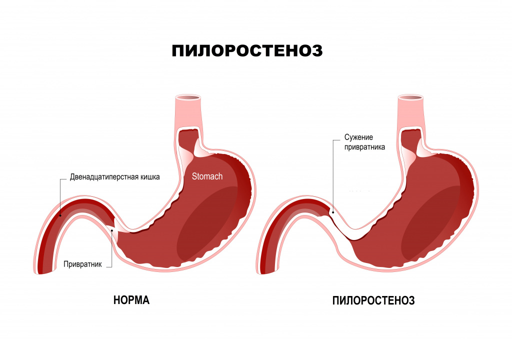 Пилоростеноз.jpg Пилоростеноз.jpg