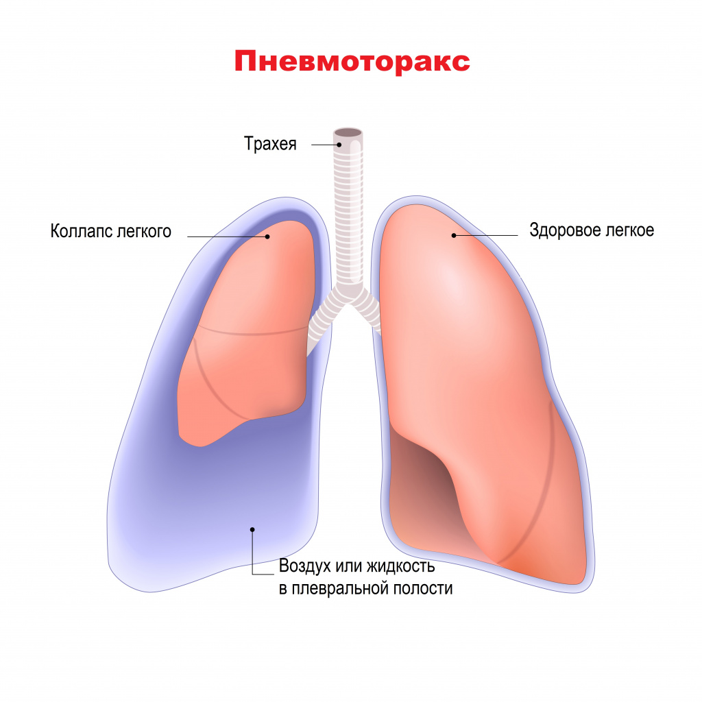 «Внесердечные» причины боли в груди - Новости поликлиники