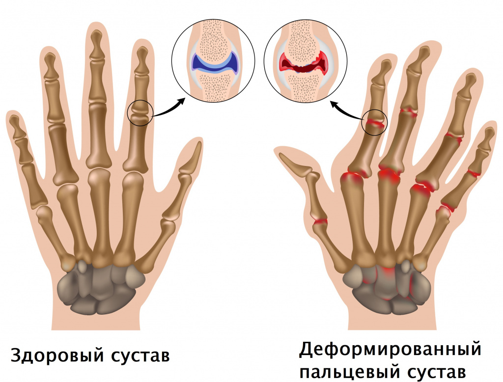Ревматоидный артрит пальцевого сустава.jpg