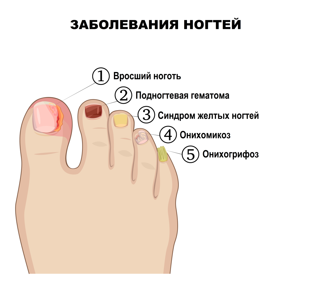 Почему болят ногти на ногах: основные причины и лечение