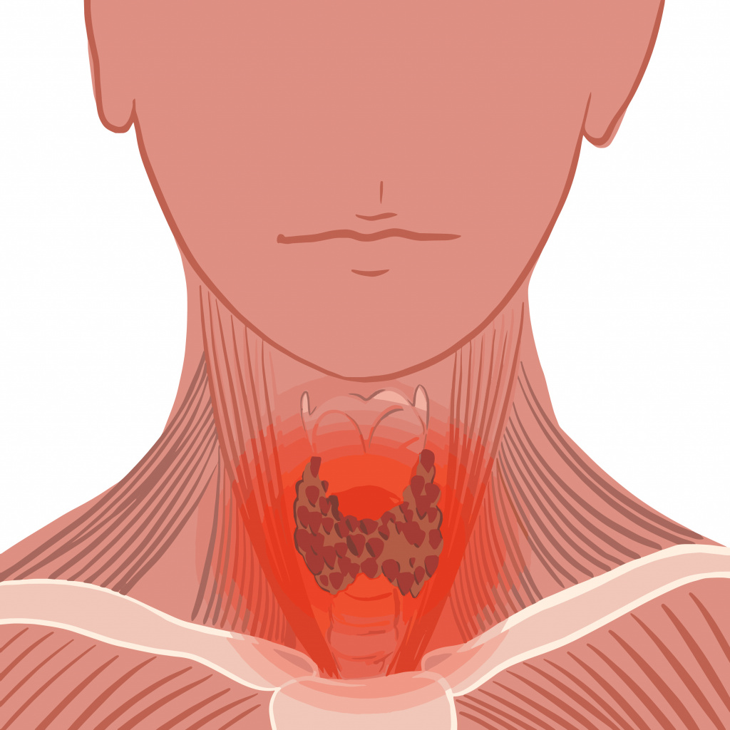 Зоб в горле. Острый тиреоидит щитовидной железы. Хронический тиреоидит ЩЖ. Тиреоидит воспаление щитовидной. Подострый тиреоидит щитовидной железы.