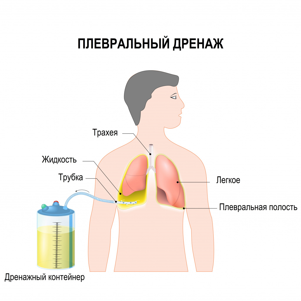 Пневмоторакс - причины появления, при каких заболеваниях возникает,  диагностика и способы лечения