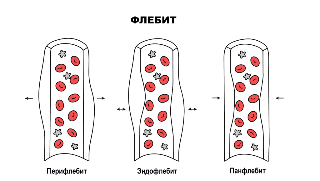 Флебит.jpg
