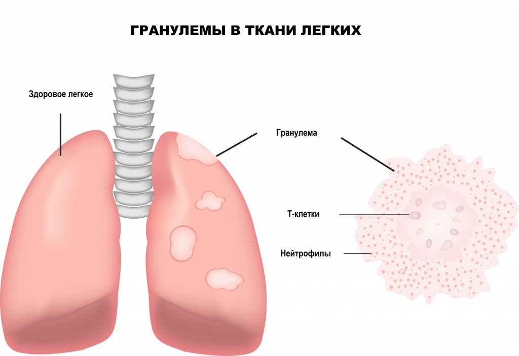Саркоидоз (болезнь Бенье-Бека-Шаумана) - причины появления, симптомы заболевания, диагностика и способы лечения