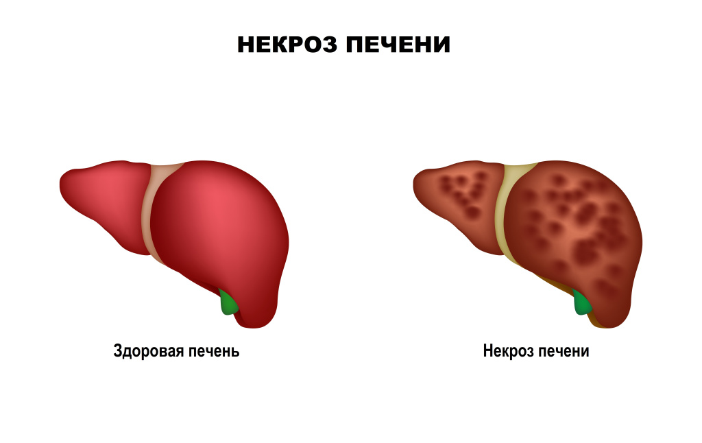 Некроз.jpg