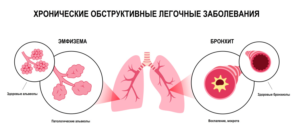 Эмфизема_Бронхит.jpg