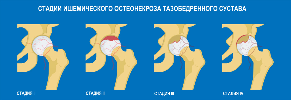 Остеонекроз.jpg