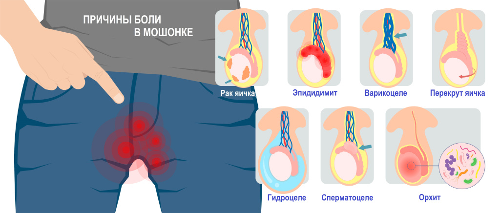Боль в мошонке.jpg