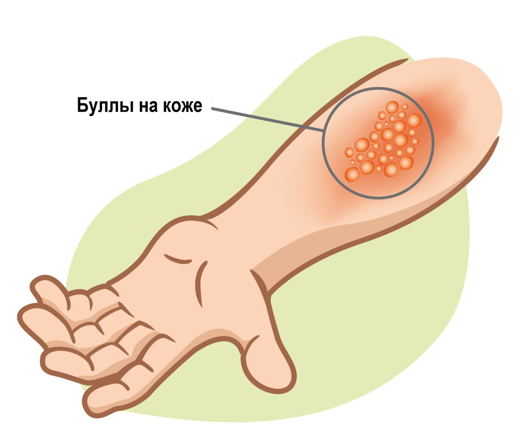 Волдыри.jpg