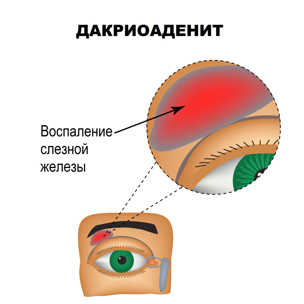 Воспаление слезной железы.jpg