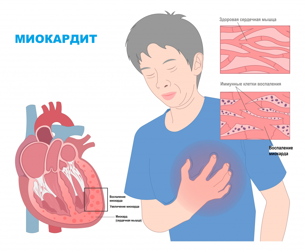 Рекомендации миокардиты 2023. Воспаление сердечной мышцы. Миокардит симптомы. Миокардит воспаление сердечной мышцы.