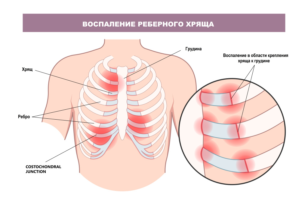 Боль в ребрах.jpg