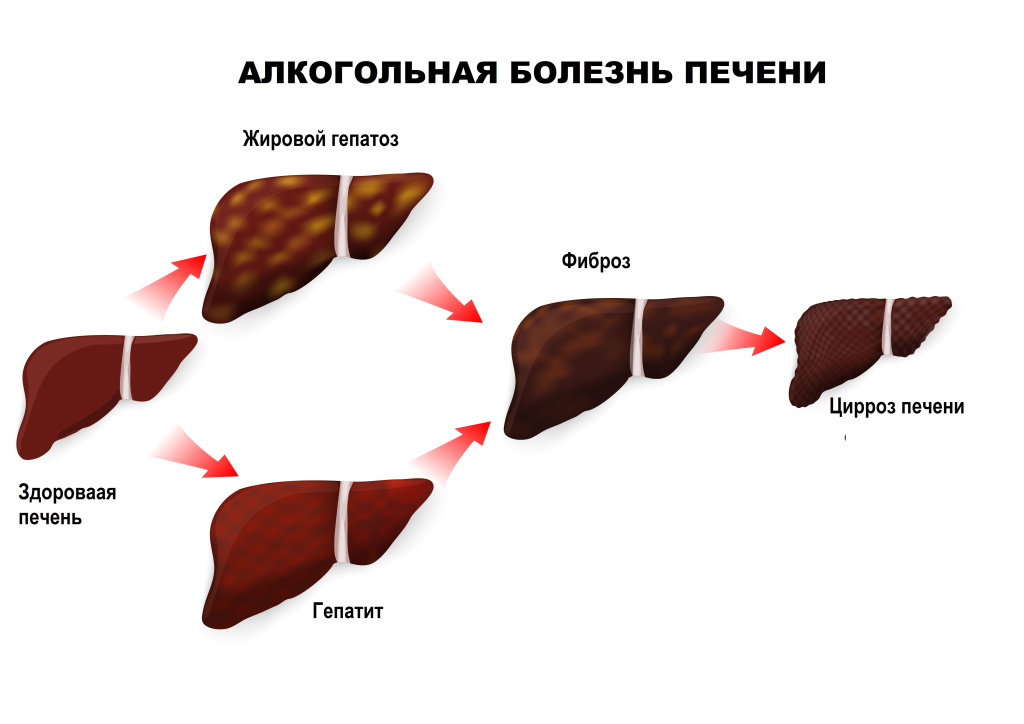 Печень и алкоголь.jpg