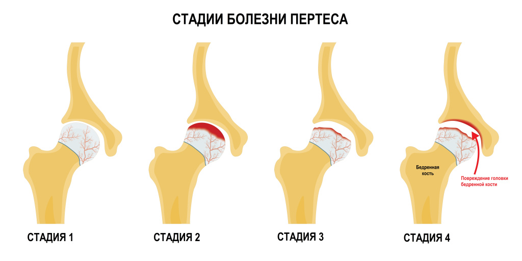 Пертес.jpg