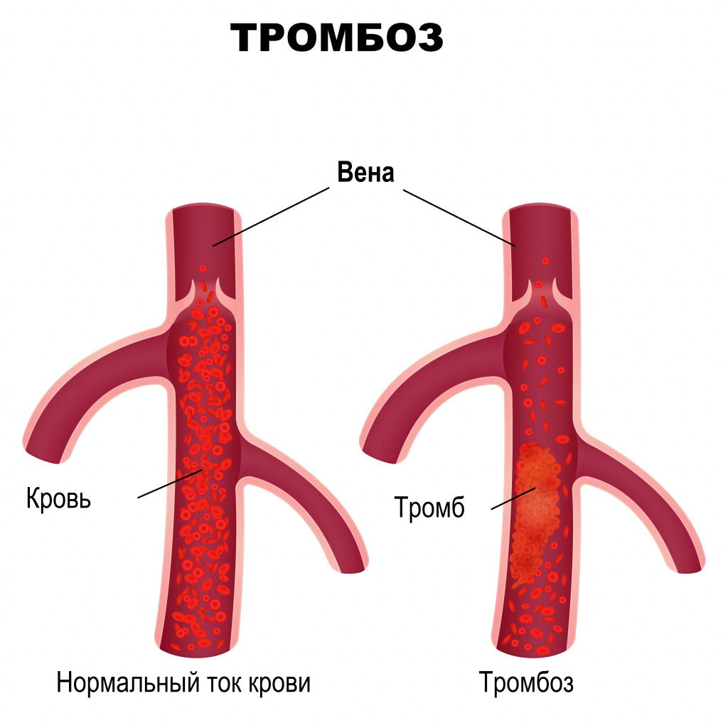 Тромбоз.jpg