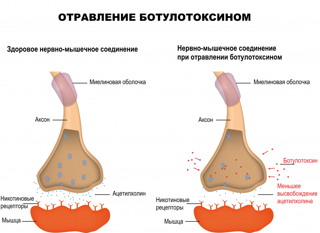 Ботулотоксин и мышца.jpg