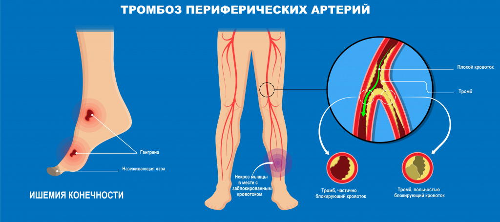 Тромбоз артерий.jpg