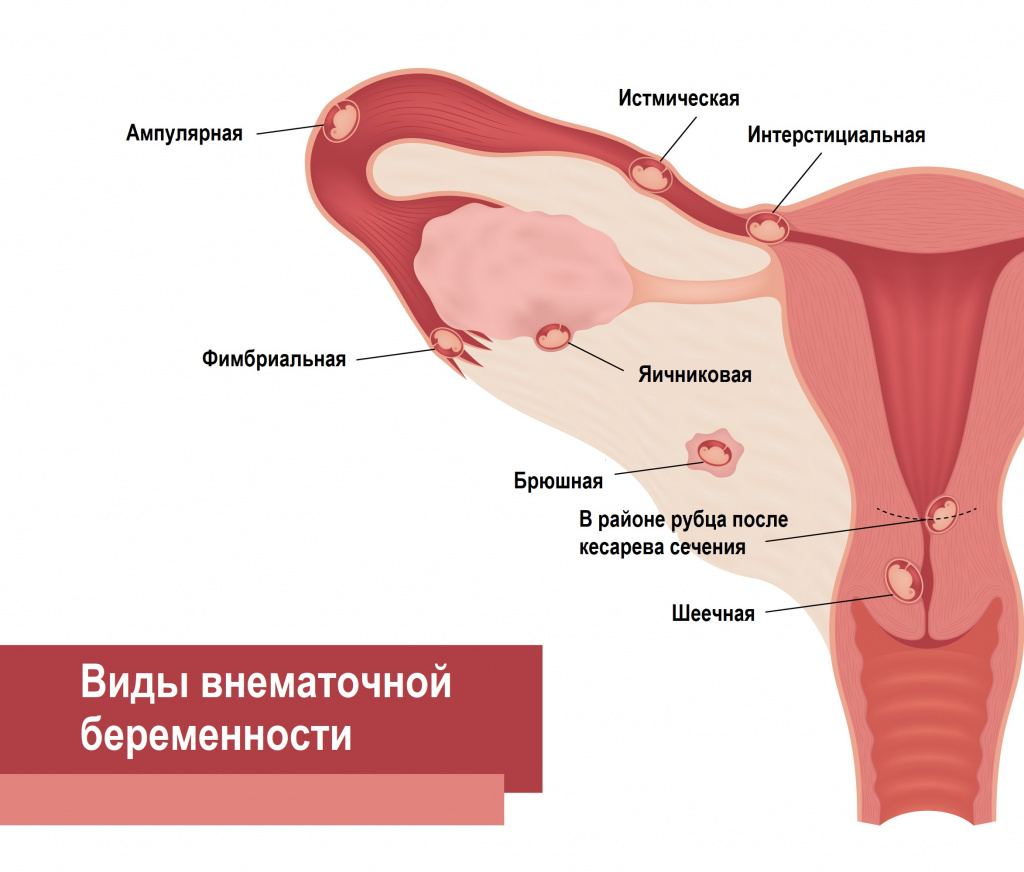 Виды внематочной беременности.jpg