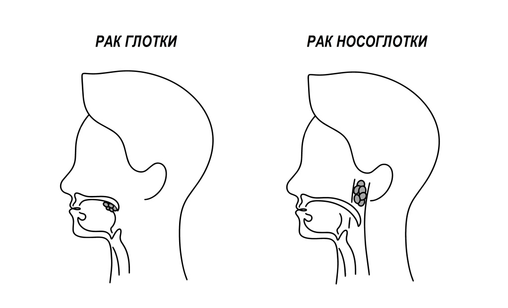 Носоглотка.jpg