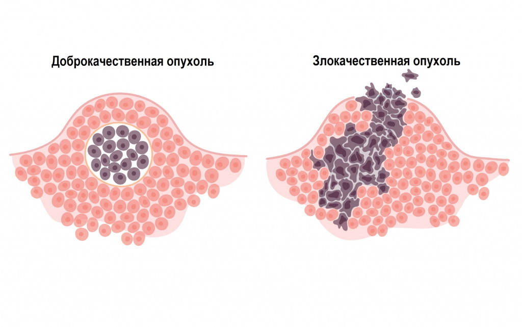 Опухоль.jpg