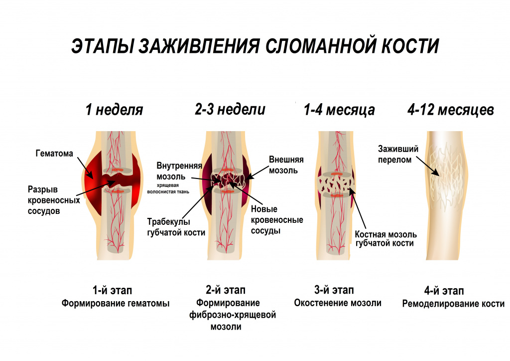 Сколько срастается трещина. Этапы заживления при переломе. Этапы заживления костного перелома. Этапы сращения кости после перелома. Заживление переломов костей стадии.