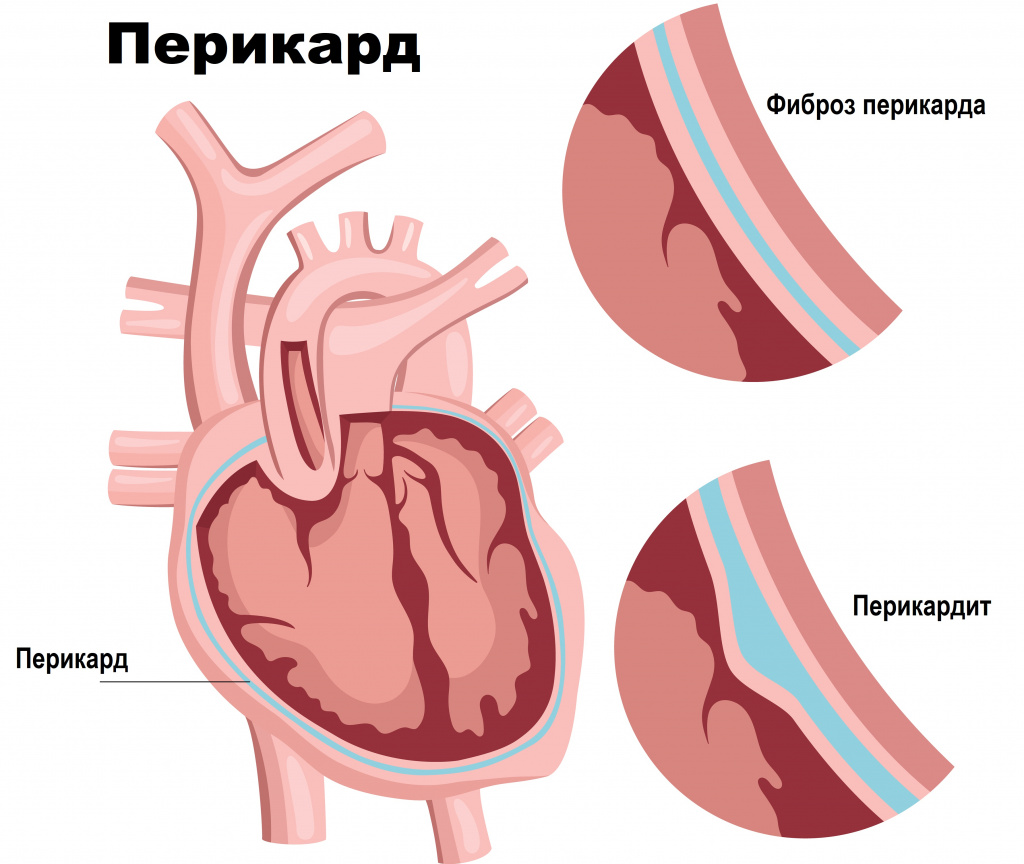 Перикардит - причины появления, симптомы заболевания, диагностика и способы  лечения