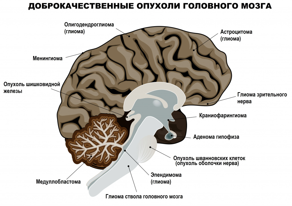 Доброкачественные опухоли головного мозга - симптомы острой и хронической  форм, стадии и признаки у мужчин и женщин, причины появления, диагностика и  лечение заболевания