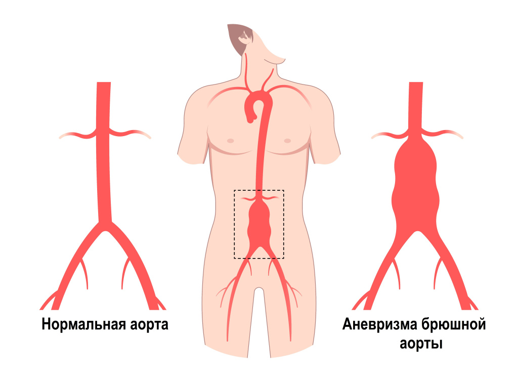 Аневризма.jpg