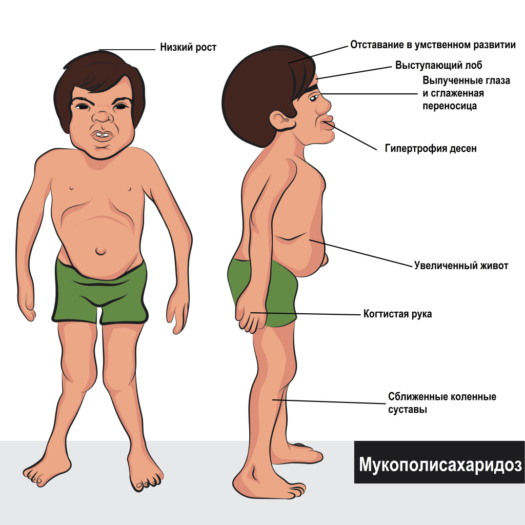 мукополисахаридоз.jpg