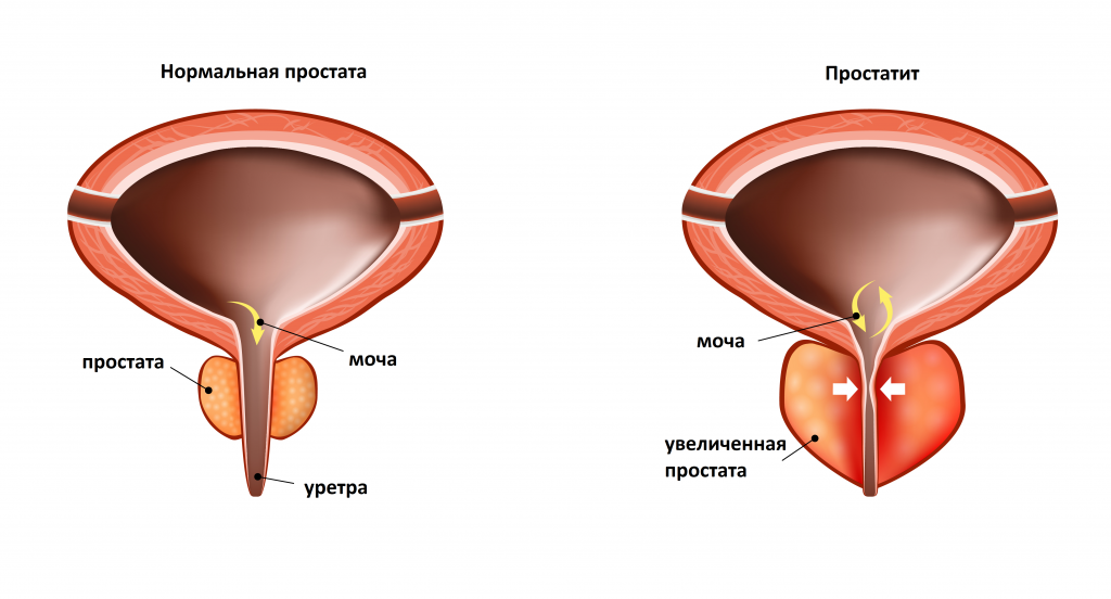 analize de prostata)