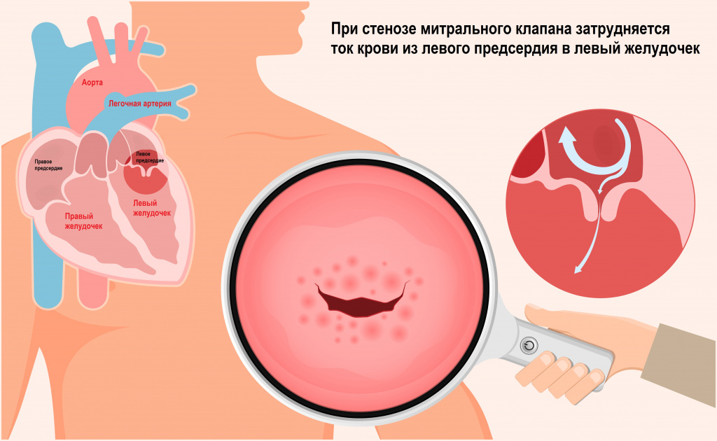 Кровоток.jpg