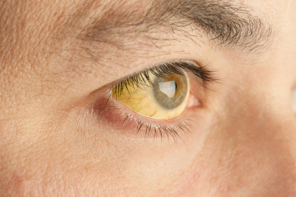 Синдром жильбера и желтые глаза thumbnail