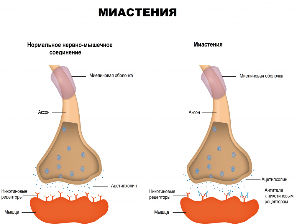 Миастения.jpg