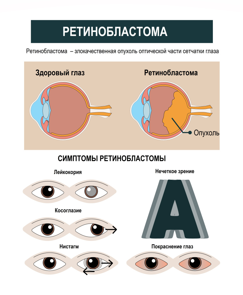 Ретинобластома.jpg