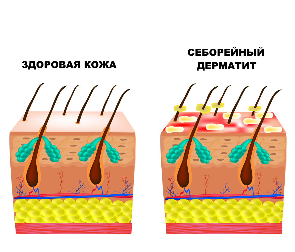 Дерматит.jpg