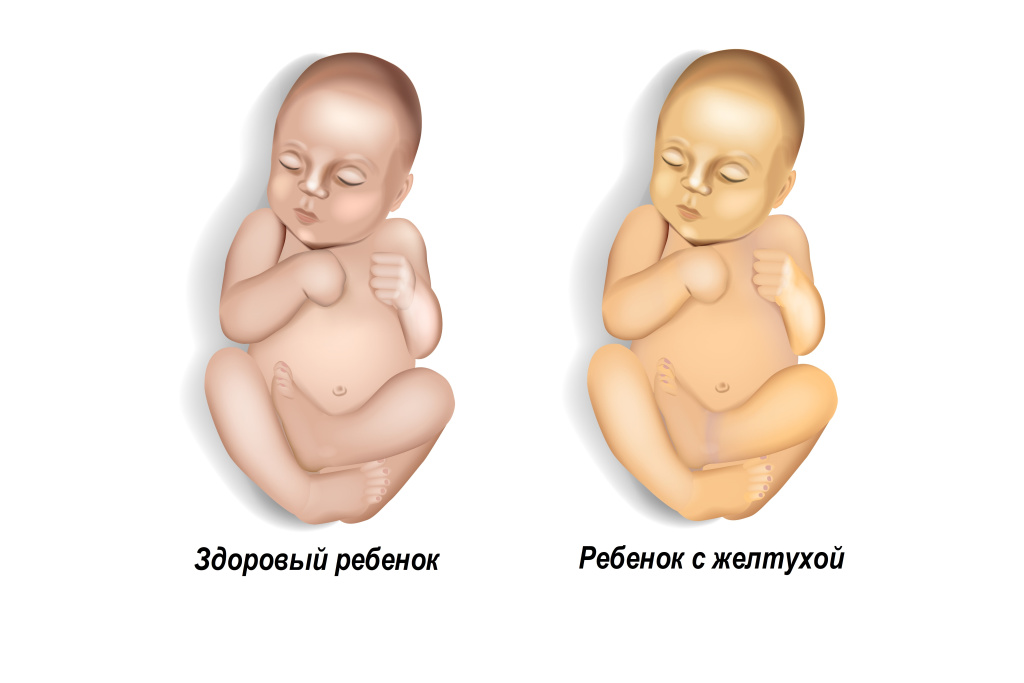 Желтуха.jpg