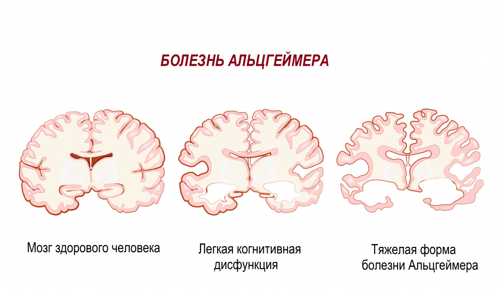 Мозг Альцгеймер.jpg