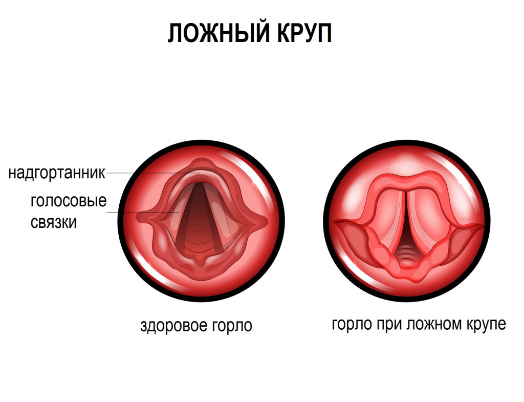 Парагрипп - причины появления, симптомы заболевания, диагностика и способы лечения